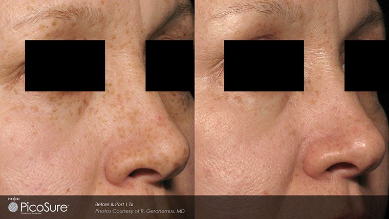 PicoSure Before and After photo by Kerin MedSpa & Laser Center in Tuckahoe, NY