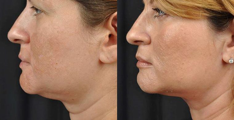 Laser Facelift Before & After | Kerin Medspa & Laser Center