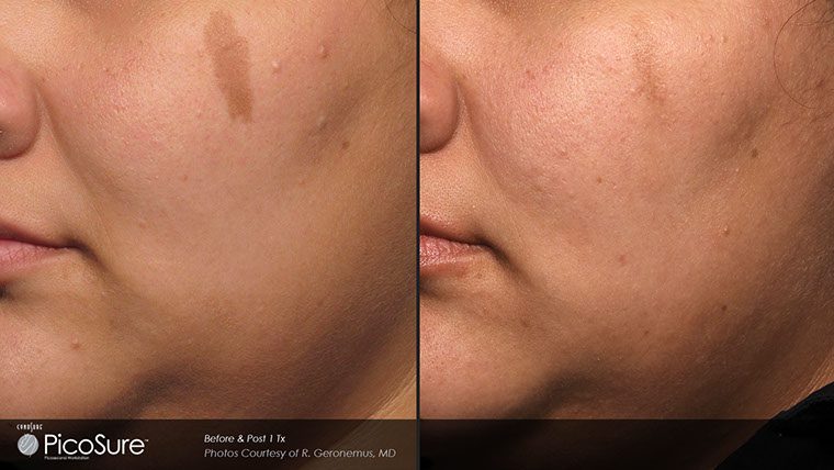 PicoSure Before and After photo by Kerin MedSpa & Laser Center in Tuckahoe, NY