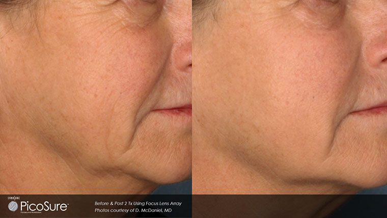 PicoSure Before and After photo by Kerin MedSpa & Laser Center in Tuckahoe, NY