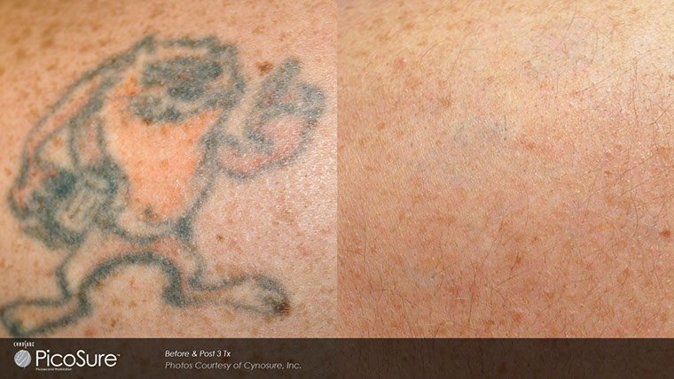 PicoSure Before and After photo by Kerin MedSpa & Laser Center in Tuckahoe, NY