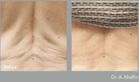 before and after morpheus body at kerin medspa