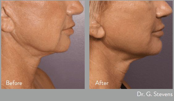 before and after morpheus body at kerin medspa