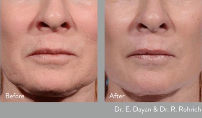 before and after morpheus at kerin medspa