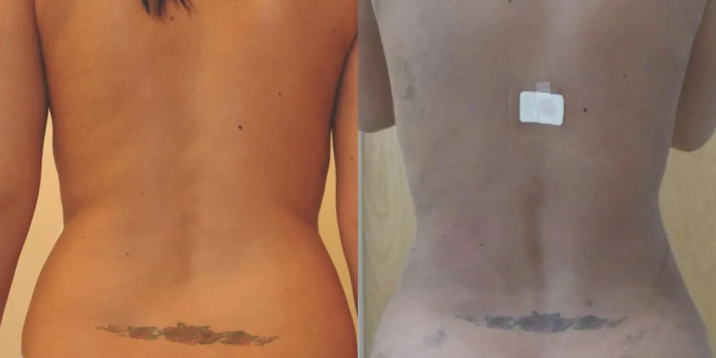 Vaser Lipo Before and After photo by Kerin MedSpa Laser Center in Tuckahoe NY