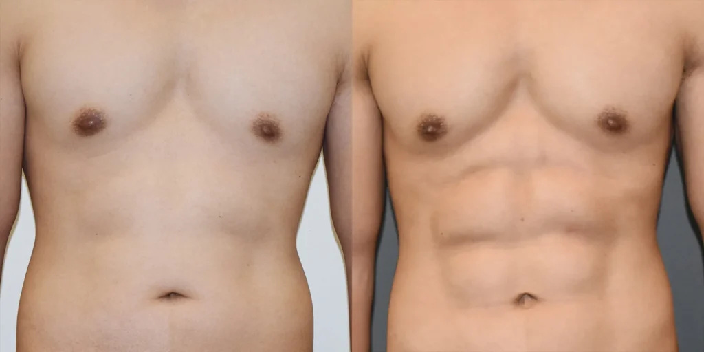 Vaser Lipo Before and After photo by Kerin MedSpa Laser Center in Tuckahoe NY