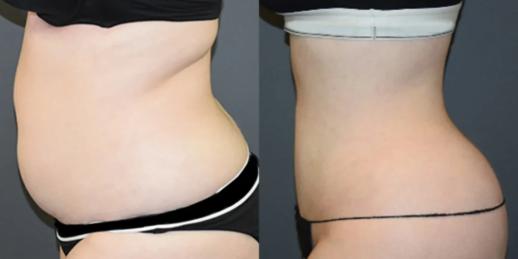 Vaser Lipo Before and After photo by Kerin MedSpa Laser Center in Tuckahoe NY