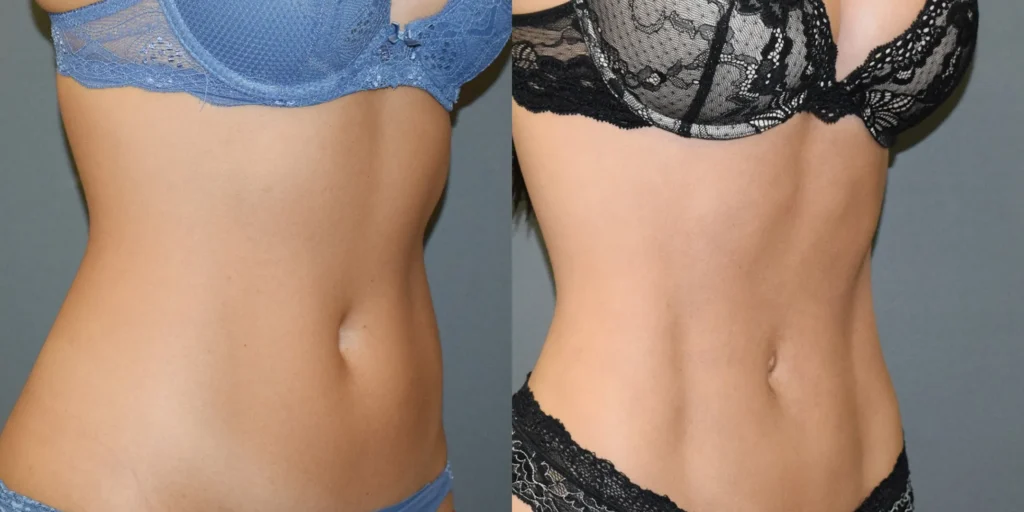 Vaser Lipo Before and After photo by Kerin MedSpa Laser Center in Tuckahoe NY